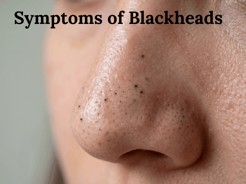 Symptoms Of Blackheads
