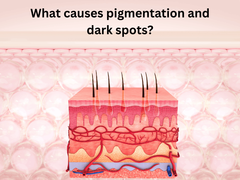 What causes pigmentation and dark spots?